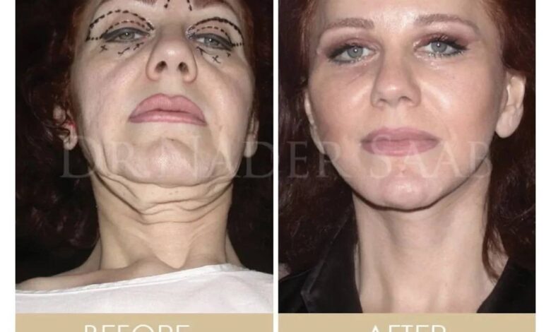 صور ميادة الحناوي قبل وبعد عمليات التجميل